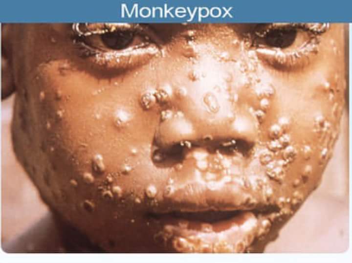 Federal Ministry of Health warns against monkey pox